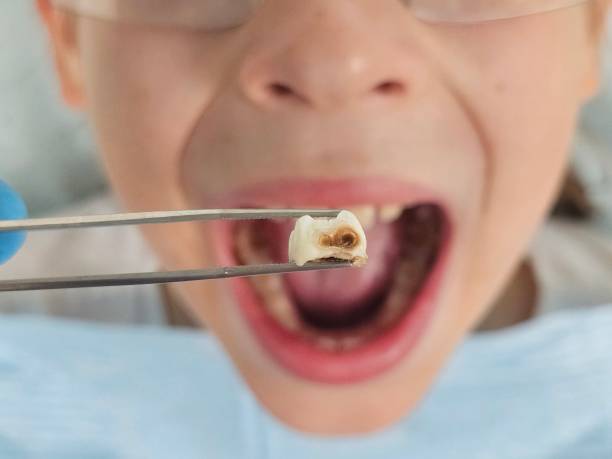 Best Emergency Treatment for Toothache in Barton, NM